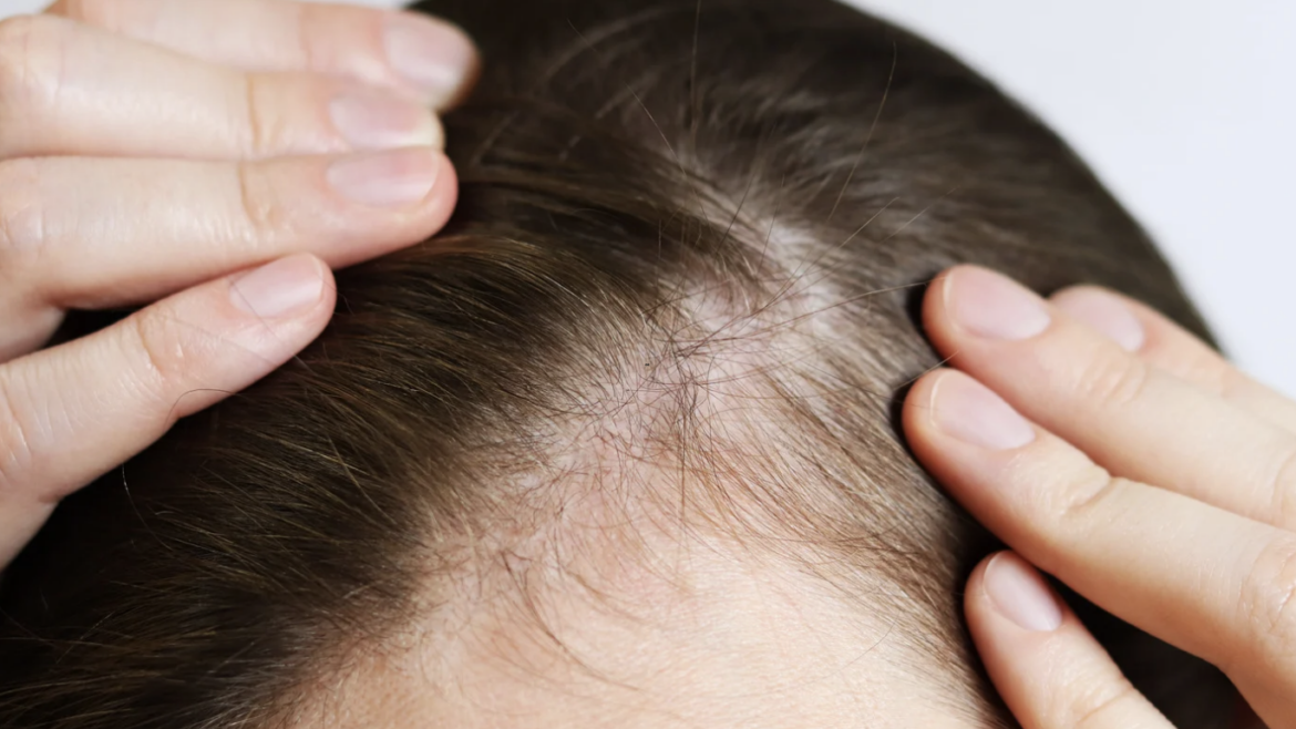 Tips to Find a Female Hair Loss Specialist Near Glen Burnie, Maryland